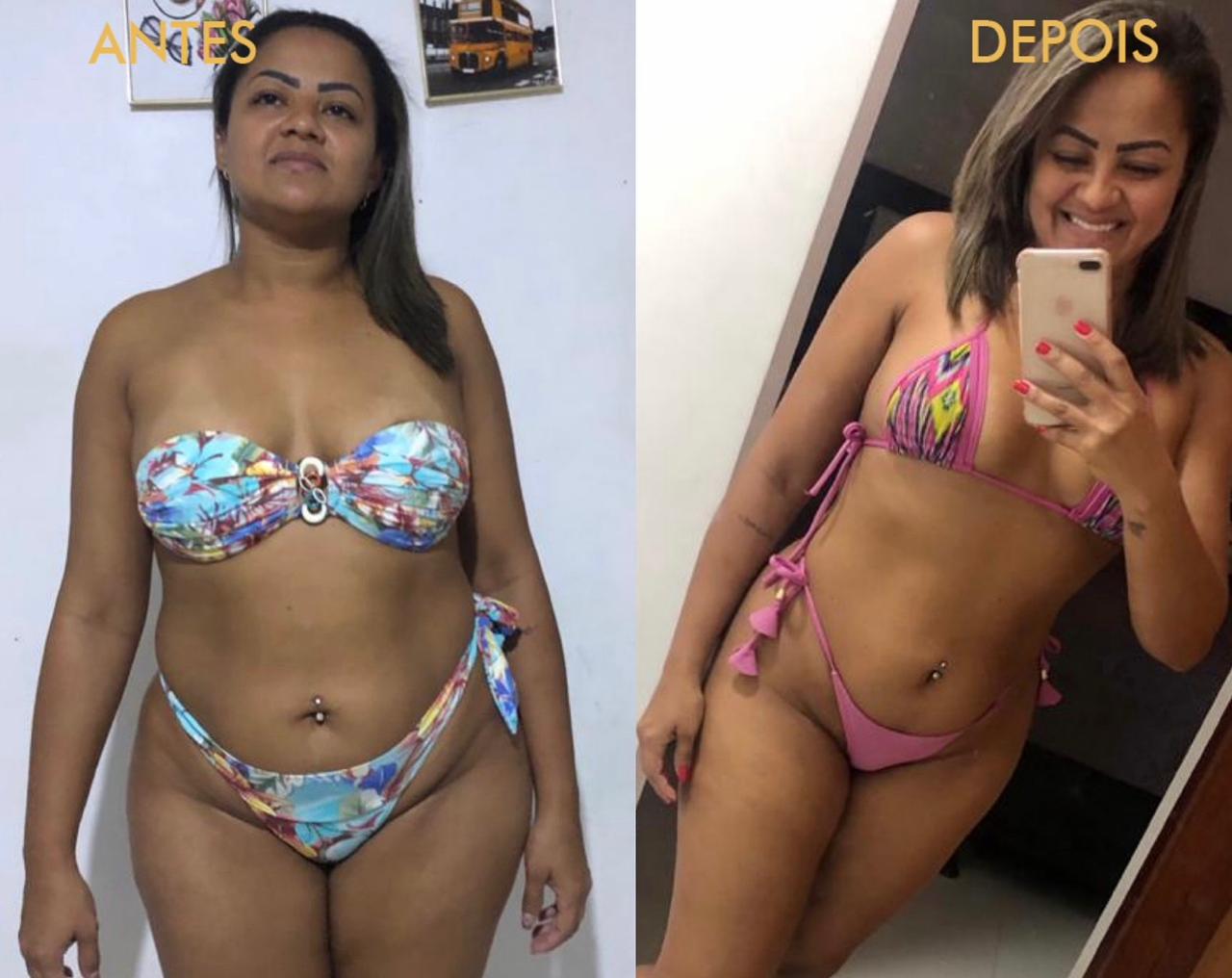 Comparação de antes e depois de uma paciente usando biquínis estampado e rosa
