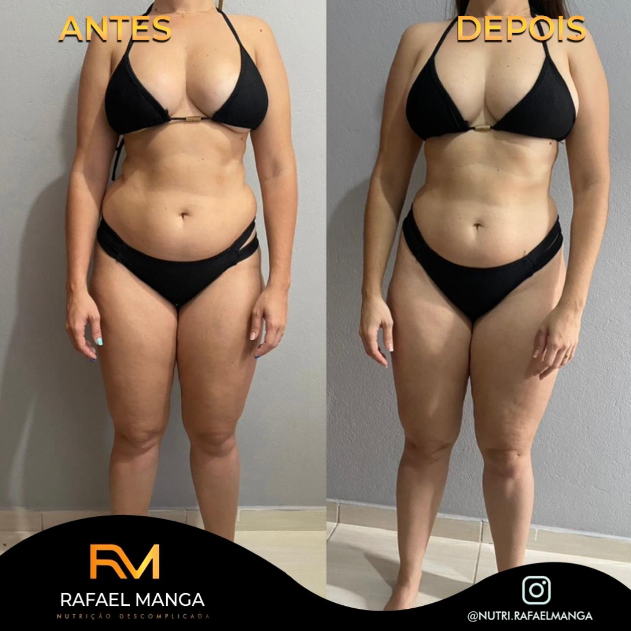Comparação de antes e depois de uma paciente usando biquíni preto em frente a uma parede clara